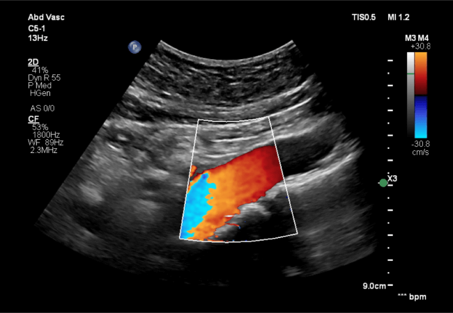 Aorta Ultrasound