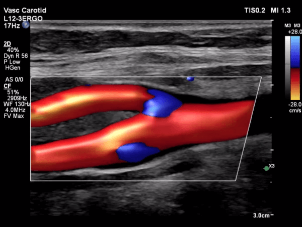 Carotid Artery Ultrasound Image 1