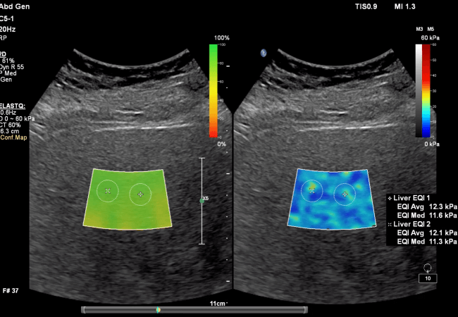 Liver Fat Quantification